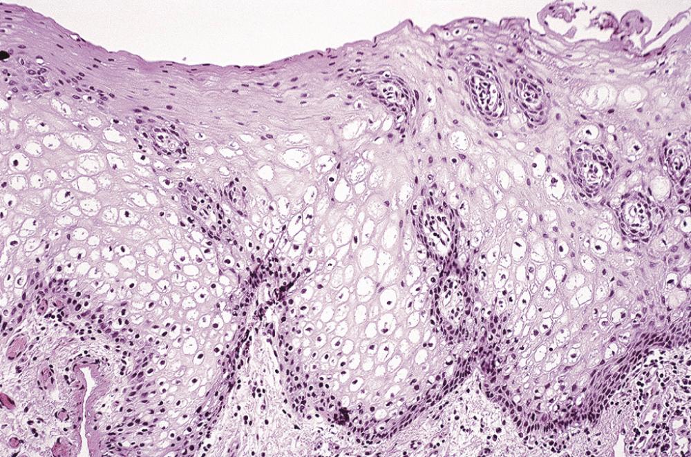 Fig. 87.2, Leukoedema demonstrates large, pale epithelial cells with peripherally displaced pyknotic nuclei and broad epithelial ridges.