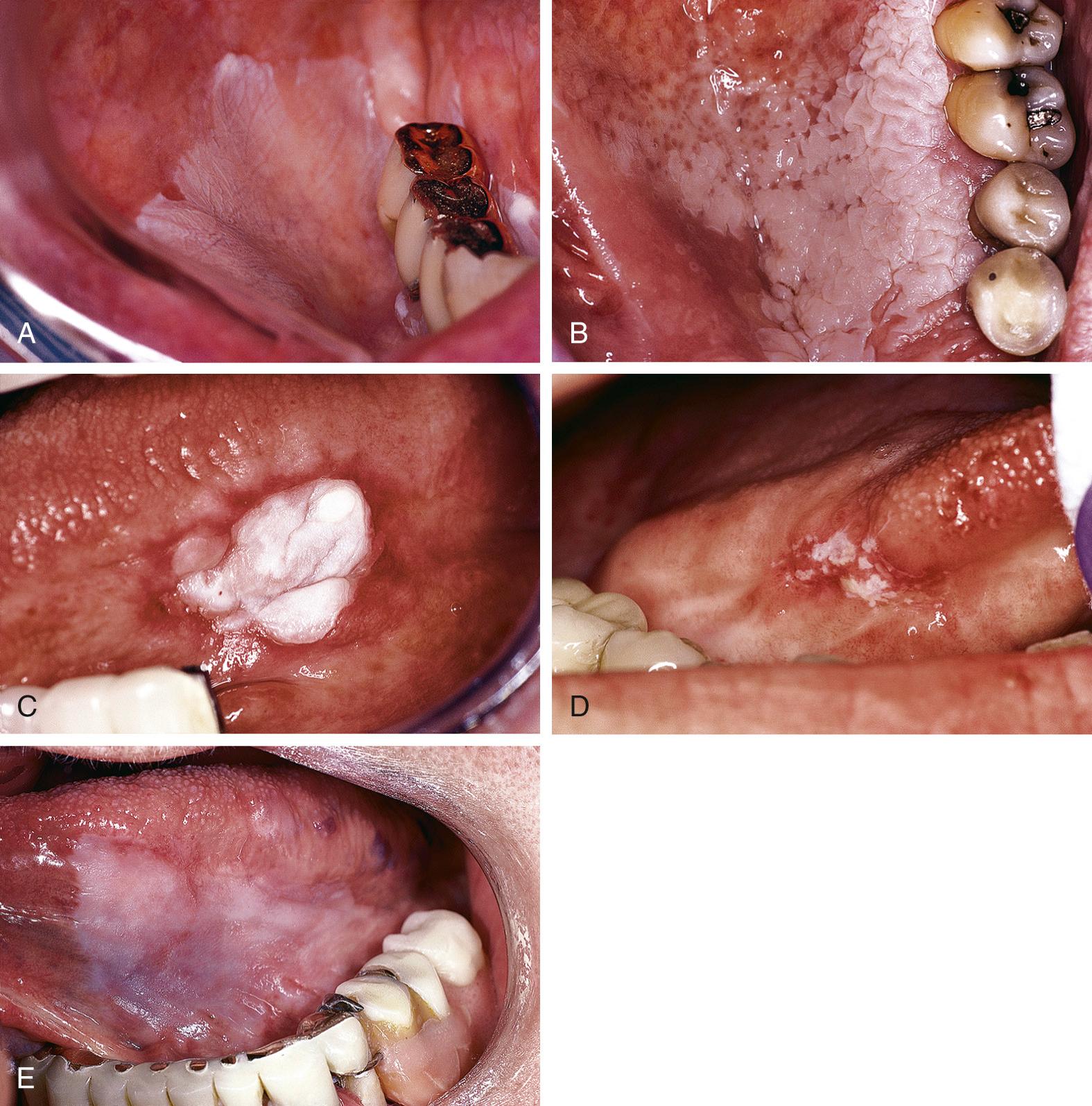 Fig. 87.5, Leukoplakia. (A) A homogeneous, slightly opaque alteration is well marginated superiorly but merges with the gingival mucosa inferiorly. (B) Hard palatal leukoplakia with a minimally elevated surface crossing the palatal midline. (C) A thick, sharply marginated focal leukoplakia of the ventral/lateral tongue with a uniform erythematous periphery. (D) Speckled or heterogeneous leukoplakia, where the leukoplakic element is set on an erythroplakia. (E) A diffuse, thin leukoplakia of the ventral tongue surface with very homogeneous qualities and slightly diffuse peripheral margins.