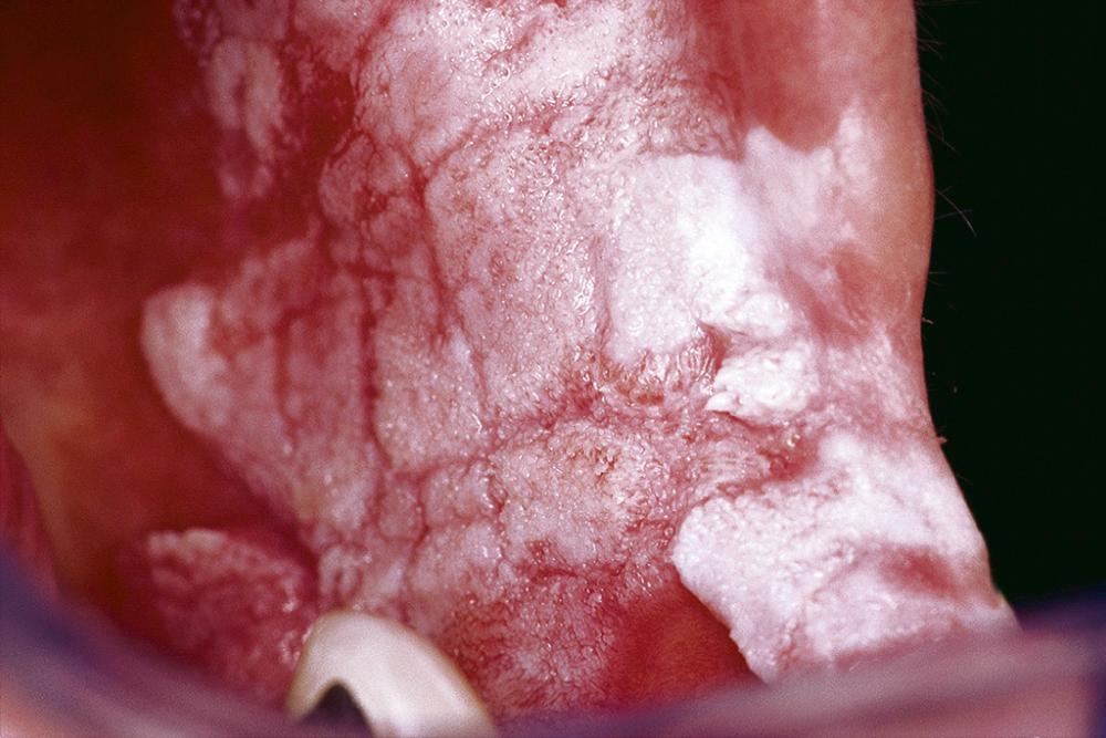 Fig. 87.6, Developing proliferative verrucous leukoplakia with a thickened, elevated surface outline and coarsely granular to minimally warty surface qualities.