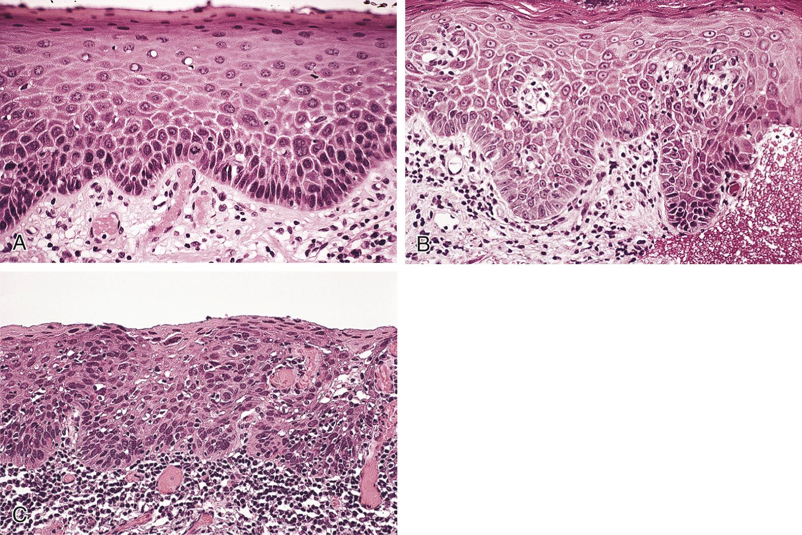 Fig. 87.7, Epithelial dysplasia. (A) Mild epithelial dysplasia with cytologic atypia confined to the lower epithelial strata. (B) Moderate epithelial dysplasia contains several layers of atypical cells; however, the upper half of the epithelial thickness remains with a normal-appearing maturational sequence. (C) Severe epithelial dysplasia with essentially full-thickness epithelial cell atypia, without evidence of invasion.