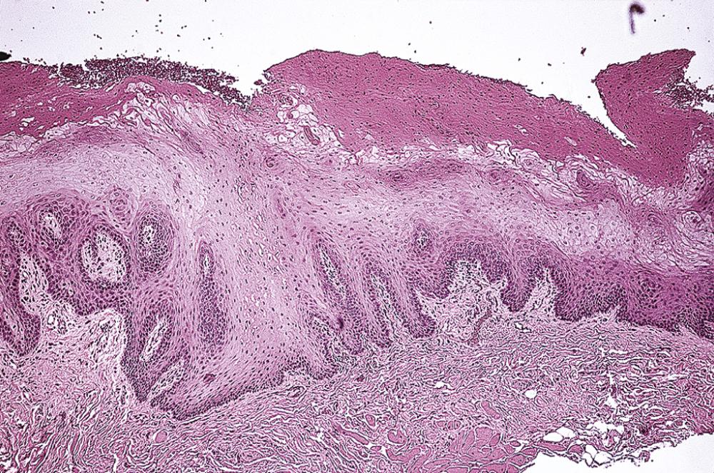 Fig. 87.9, A low-power view of oral hairy leukoplakia shows a thick parakeratotic surface layer and a characteristic pale subsurface layer above the spinous layer.