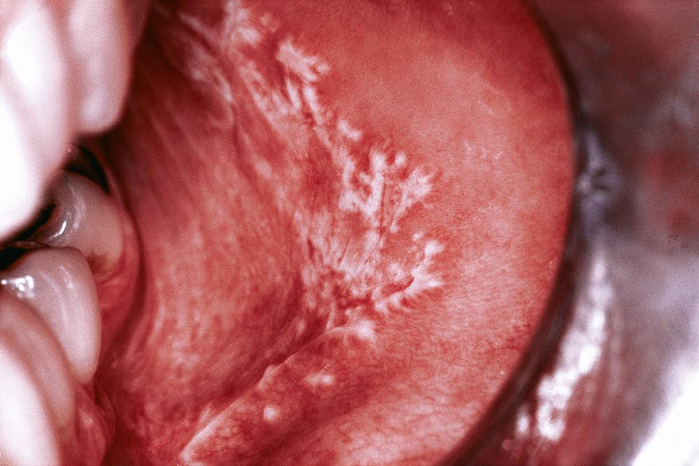 Fig. 87.10, Reticular-type lichen planus with delicate striae over the posterior buccal mucosa.