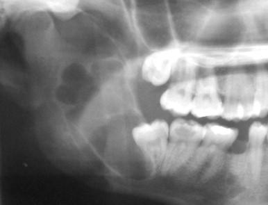 Figure 1-2, Preoperative panoramic radiograph showing a large multilocular radiolucent lesion of the right mandible body and ramus associated with an impacted third molar.