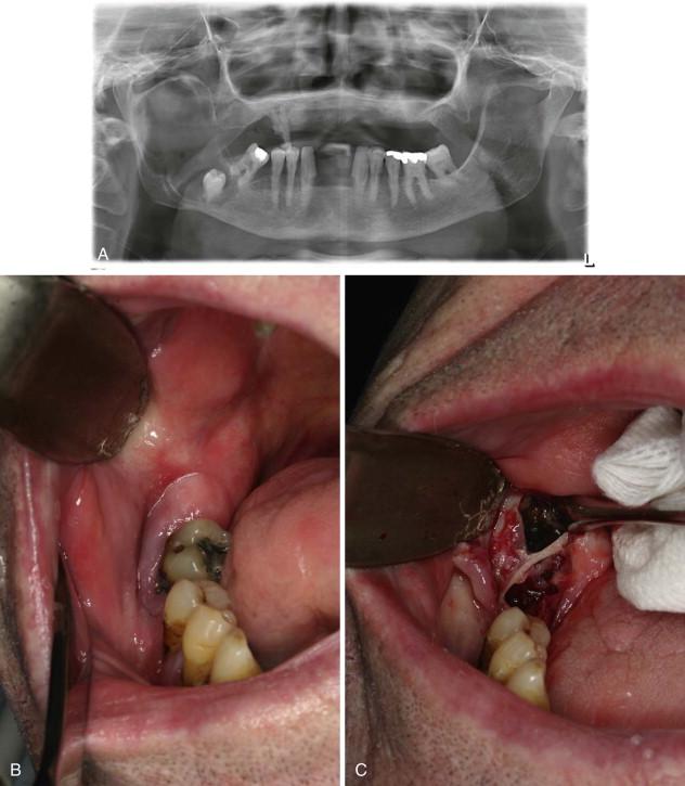 Figure 1-3, A, Unilocular radiolucency from posterior mandibular body to sigmoid notch. B, Preoperative photograph demonstrating absence of tooth #32. C, Initial exposure of the lesion. D, Unroofing of the lesion and exposure of tooth #32. E, Surgical defect after enucleation and curettage of the lesion. F, Orthopantogram 6 weeks after enucleation and curettage of the lesion. G, Orthopantogram 16 weeks after enucleation and curettage of the lesion.