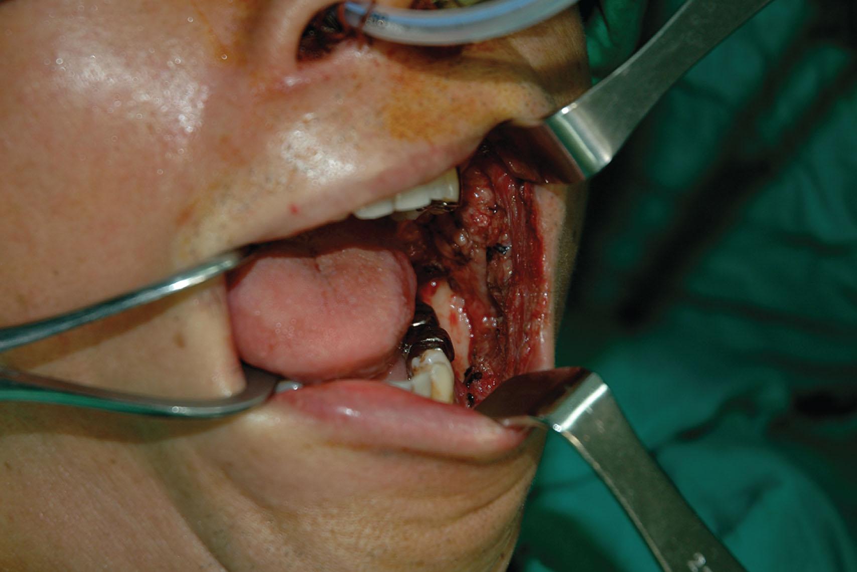 Figure 12.1, A 55-year-old male patient sustained of left buccal carcinoma, stage 2. A left buccal mucosa defect remained after tumor resection with a left modified radical neck dissection.