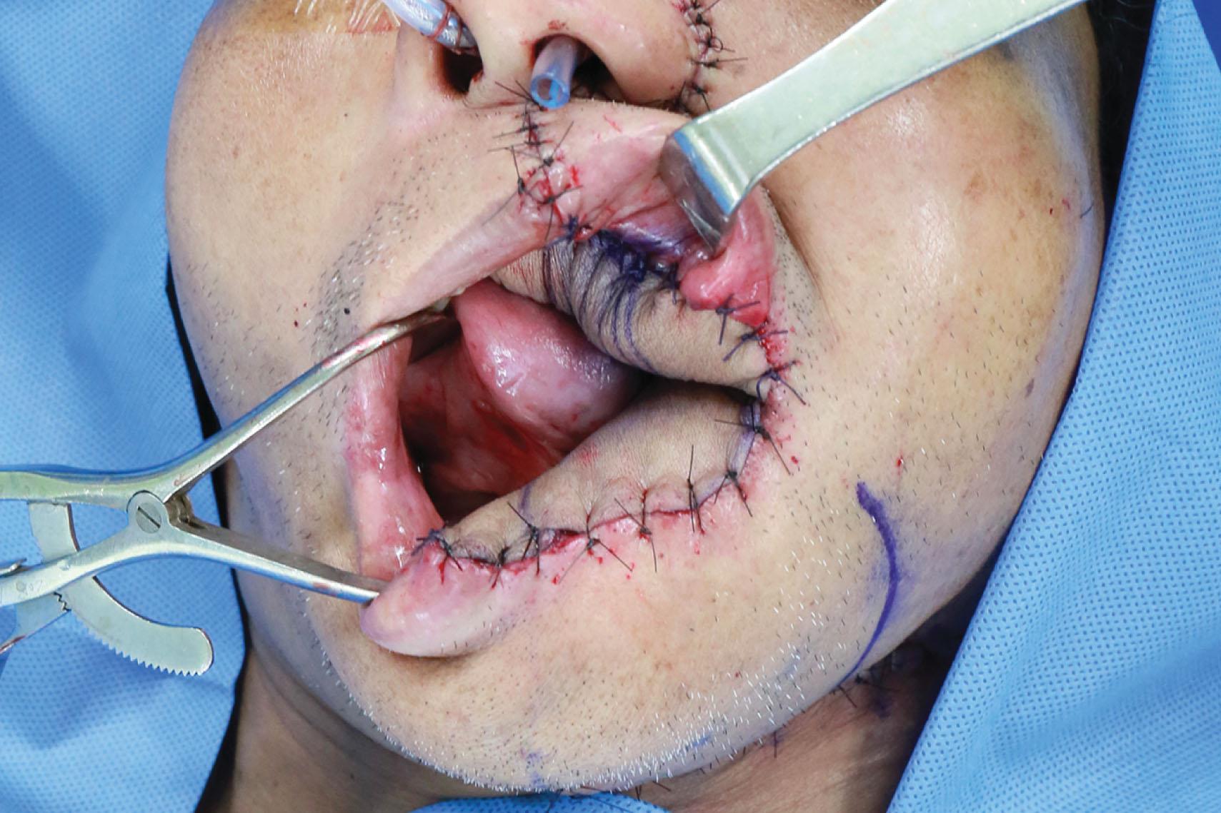 Figure 12.11, The inferior anterior maxilla was reconstructed with a segment, 2.5 cm in length, of costal bone graft from the left 7th rib ( Video 12.1 ). Immediate result of the left composite inferior maxillary, buccal, and lower lip defects reconstructed with a femoral profunda artery perforator flap.