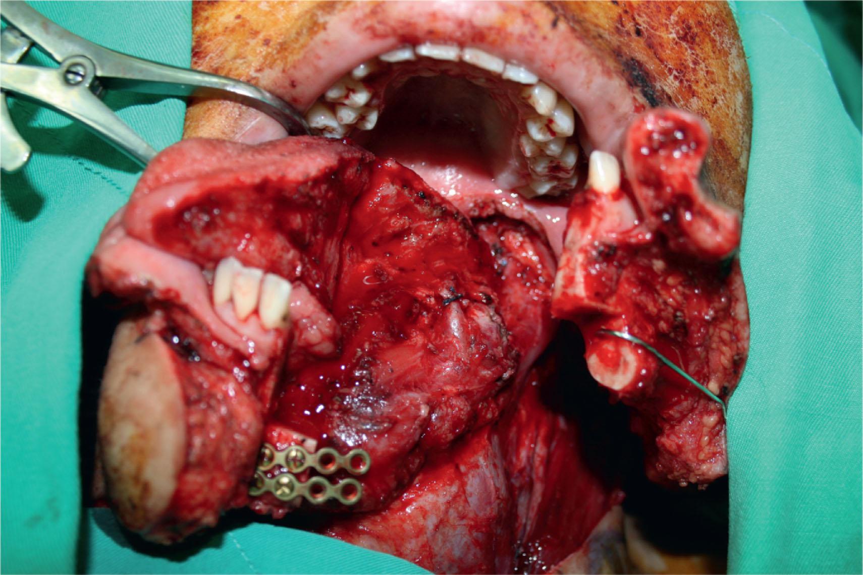 Figure 12.12, A 27-year-old male patient sustained a hemi-tongue defect after cancer resection.