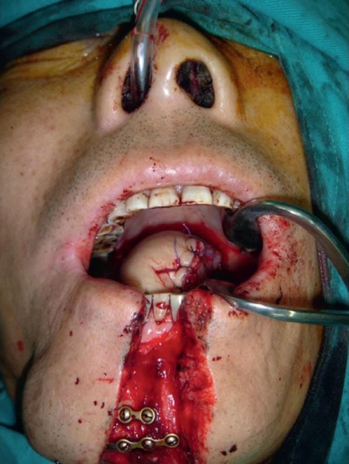 Figure 12.17, The reconstructed tongue showed good projection and adequate volume by the chimeric medial sural artery perforator flap.