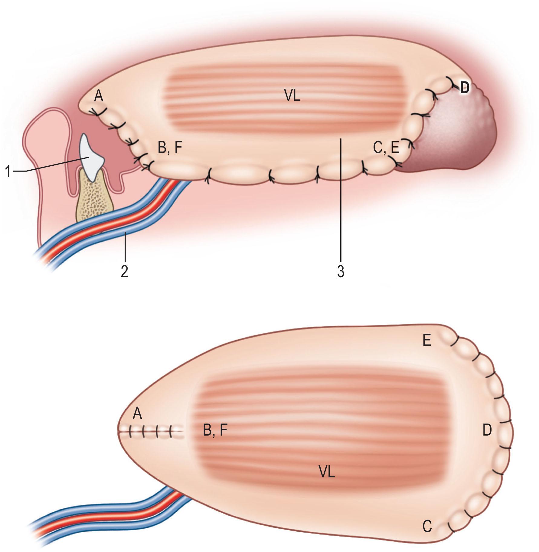 Figure 12.19, A pentagonal anterolateral thigh musculocutaneous flap sized 10 × 15 cm with a segment of vastus lateralis is used to reconstruct a total tongue defect. The distance from B to F is 10 cm and from A to D is 15 cm. The vastus lateralis is 5 × 10 cm. B and F are sutured to form the floor of the mouth, and A becomes the tip of the neotongue. The margins between B and C and E and F are repaired to the gingival mucosa of the mandible. The distance between C, D, and E forms the base of the tongue and trigone. The pedicle is placed anteriorly to reach the recipient vessels in the neck. A, tongue tip; B and F, floor of mouth; C and E, trigone; D, base of tongue; VL, vastus lateralis muscle; 1, teeth; 2, lateral circumflex femoral vessels; 3, anterolateral thigh musculocutaneous flap.