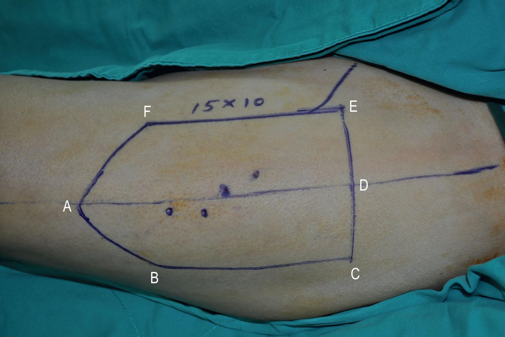 Figure 12.21, A pentagonal-shape anterolateral thigh myocutaneous flap that measured 10 × 15 cm was designed on the left thigh.