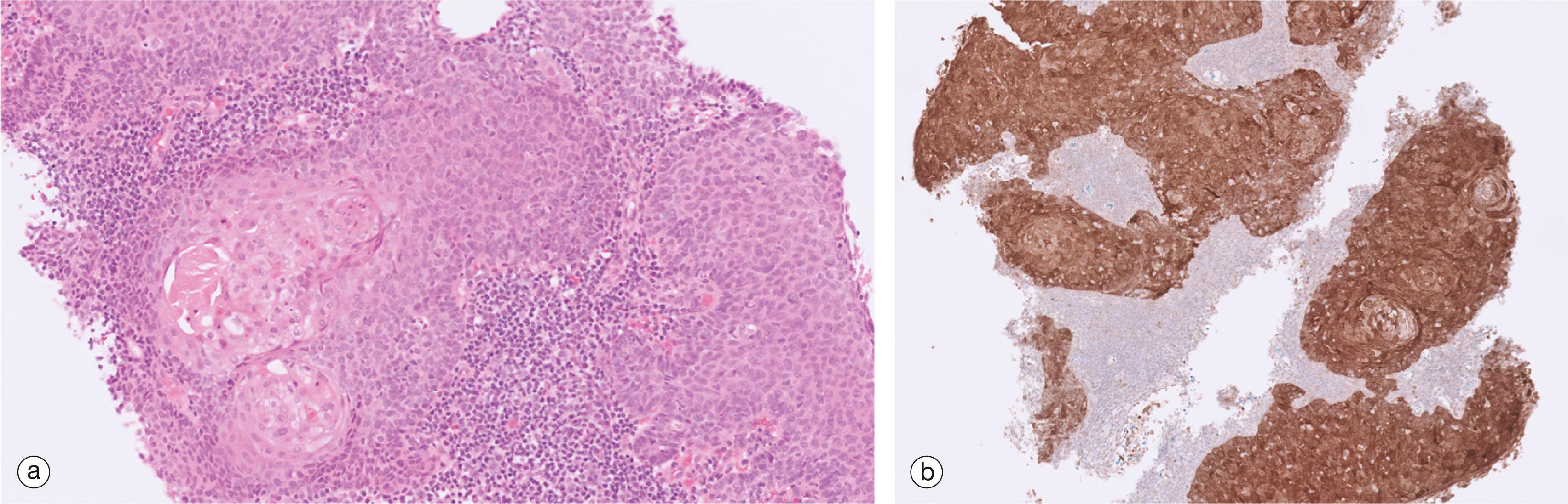 E-fig. 13.4, p16 positive squamous cell carcinoma(a) H&E (MP) (b) Immunohistochemistry for p16 (MP)