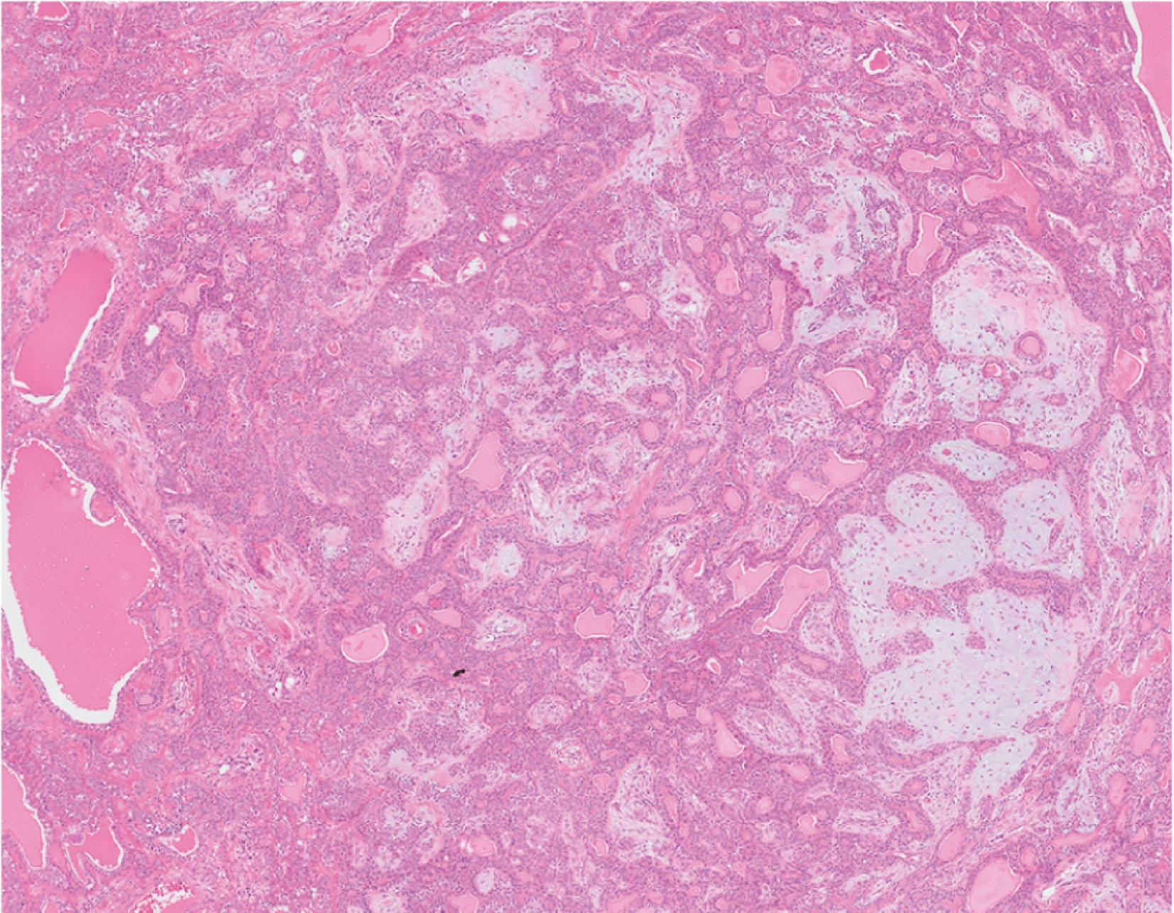 E-fig. 13.5, Pleomorphic adenoma (LP)