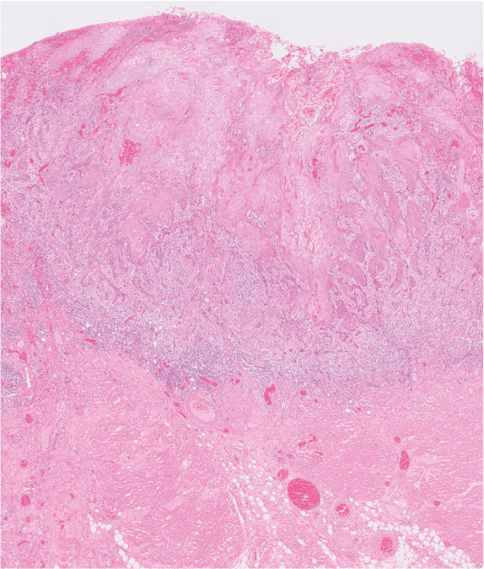 E-fig. 13.1, Oral squamous cell carcinoma (LP)