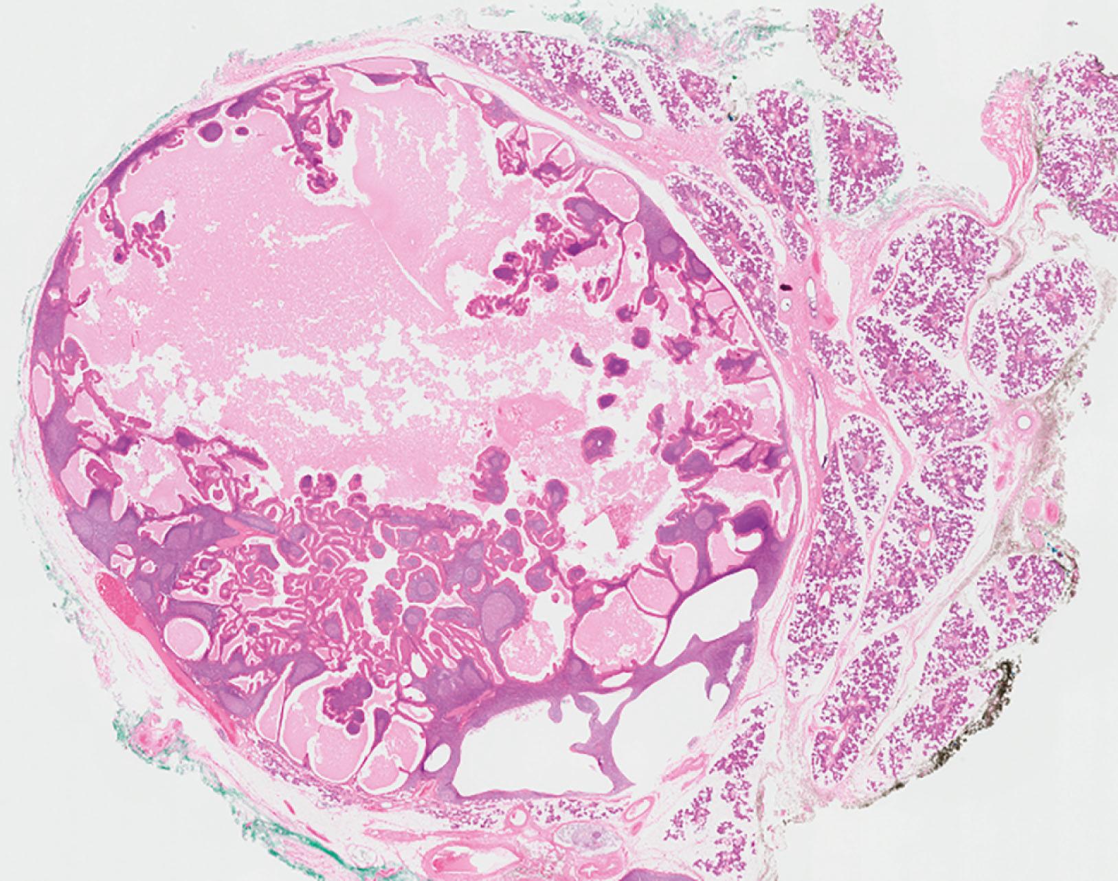 E-fig. 13.6, Warthin’s tumour (LP)