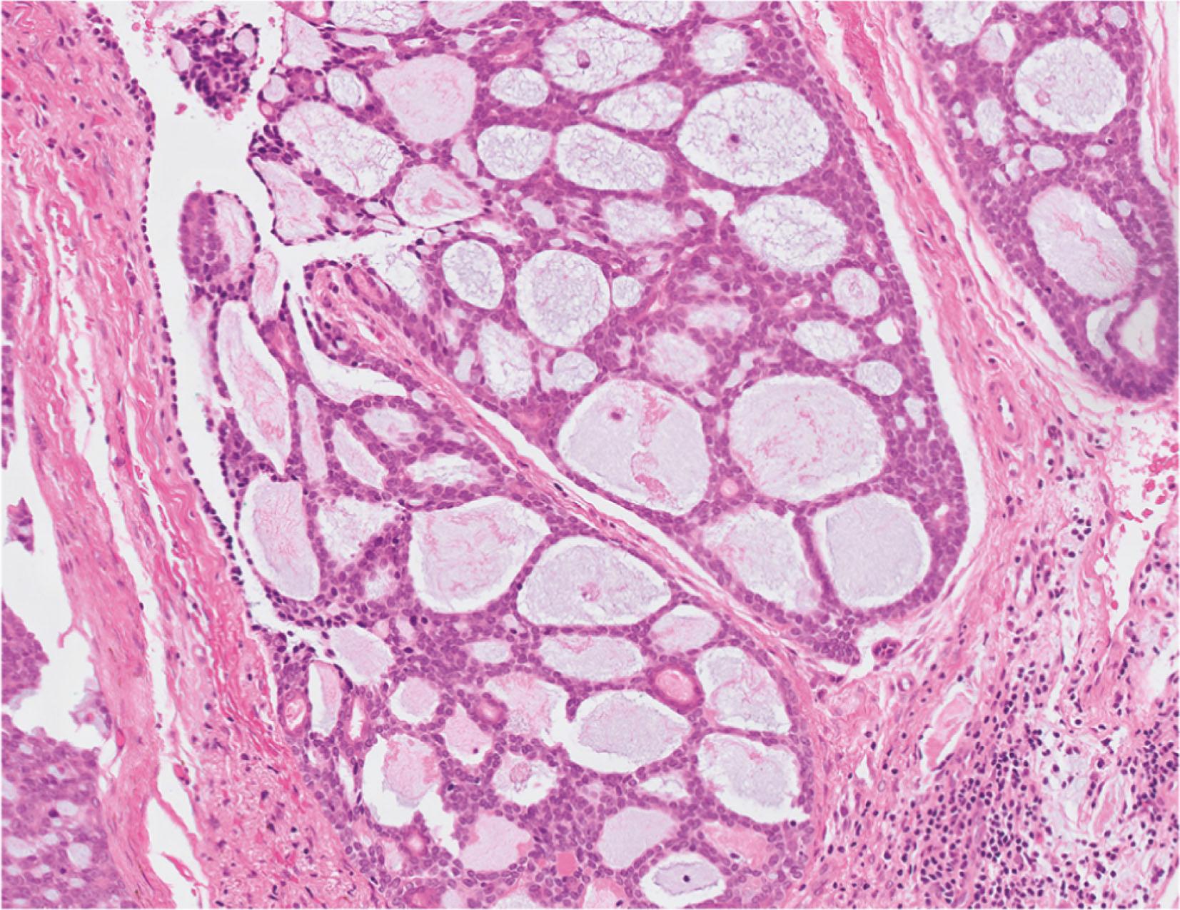 E-fig. 13.7, Adenoid cystic carcinoma (MP)