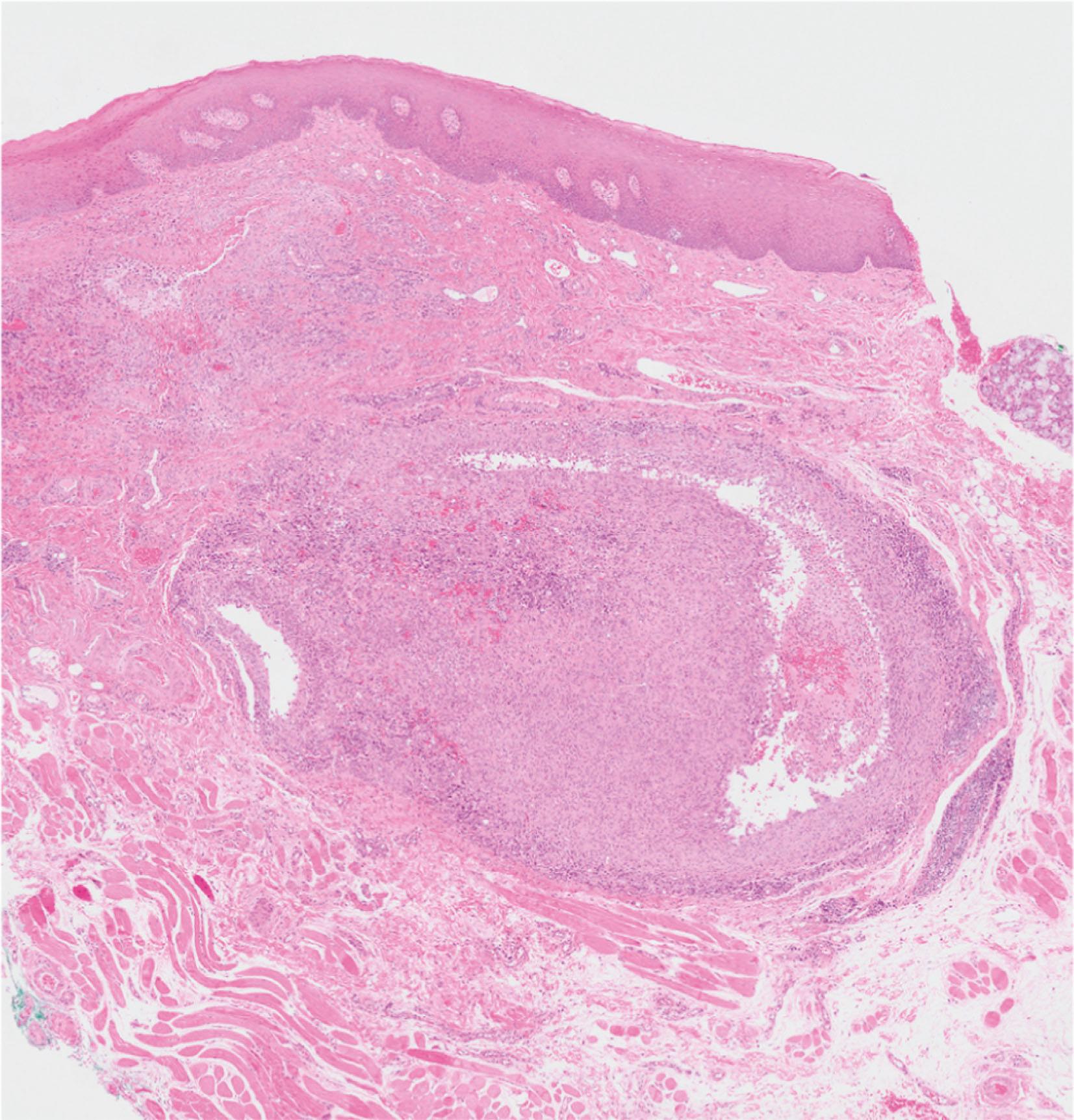 E-fig. 13.9, Mucocoele (LP)