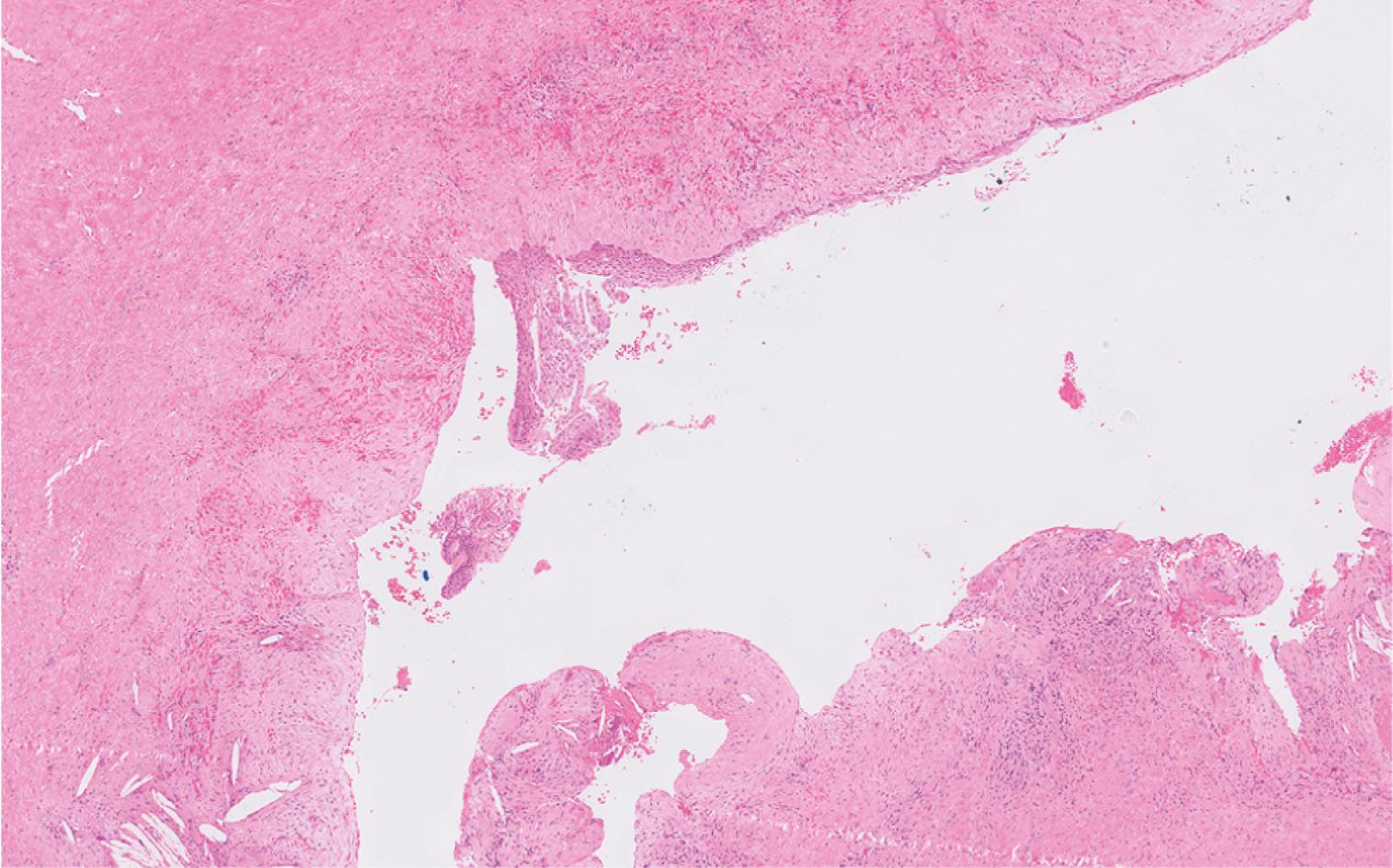 E-fig. 13.3, Radicular cyst (LP)