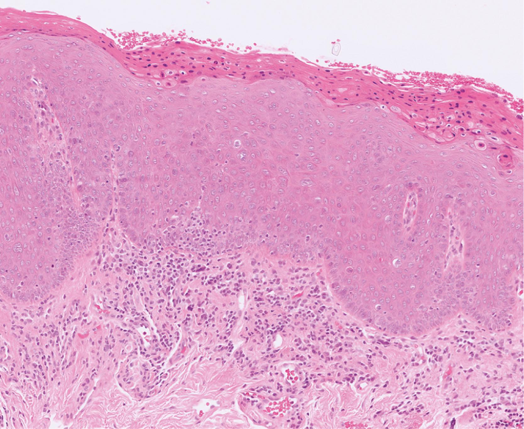 E-fig. 13.2, Squamous dysplasia (MP)