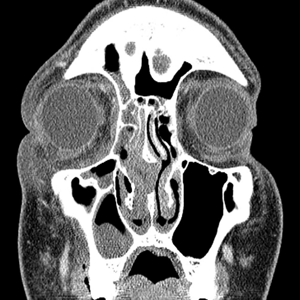 Fig. 152.3, Contrast-enhanced computer tomography displaying coronal view of right subperiosteal orbital abscess.