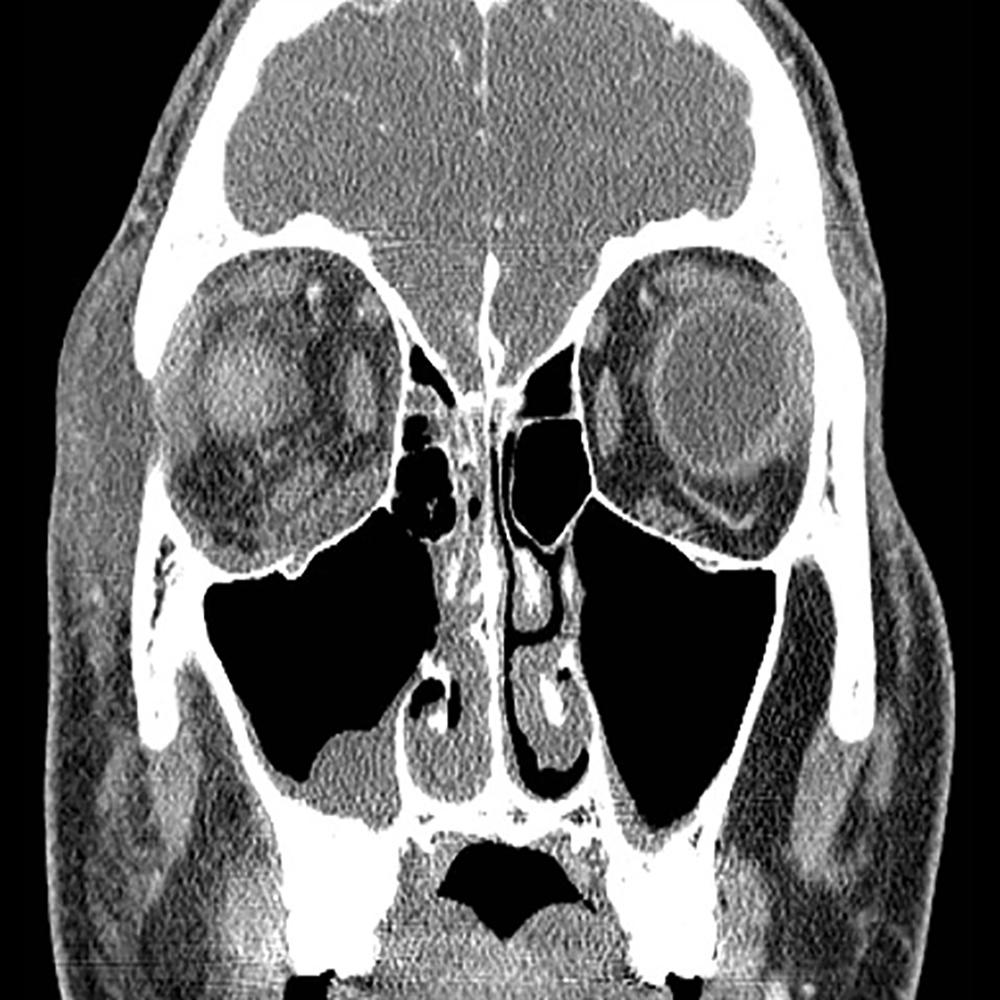 Fig. 152.4, Contrast-enhanced computer tomography displaying more posterior coronal view of right subperiosteal orbital abscess.