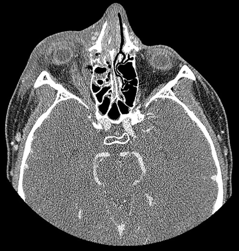 Fig. 152.5, Contrast-enhanced computer tomography displaying axial view of right subperiosteal orbital abscess.