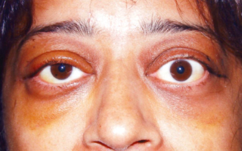 Fig. 151.2, Patient with Graves orbitopathy 6 days after balanced decompression of both eyes.