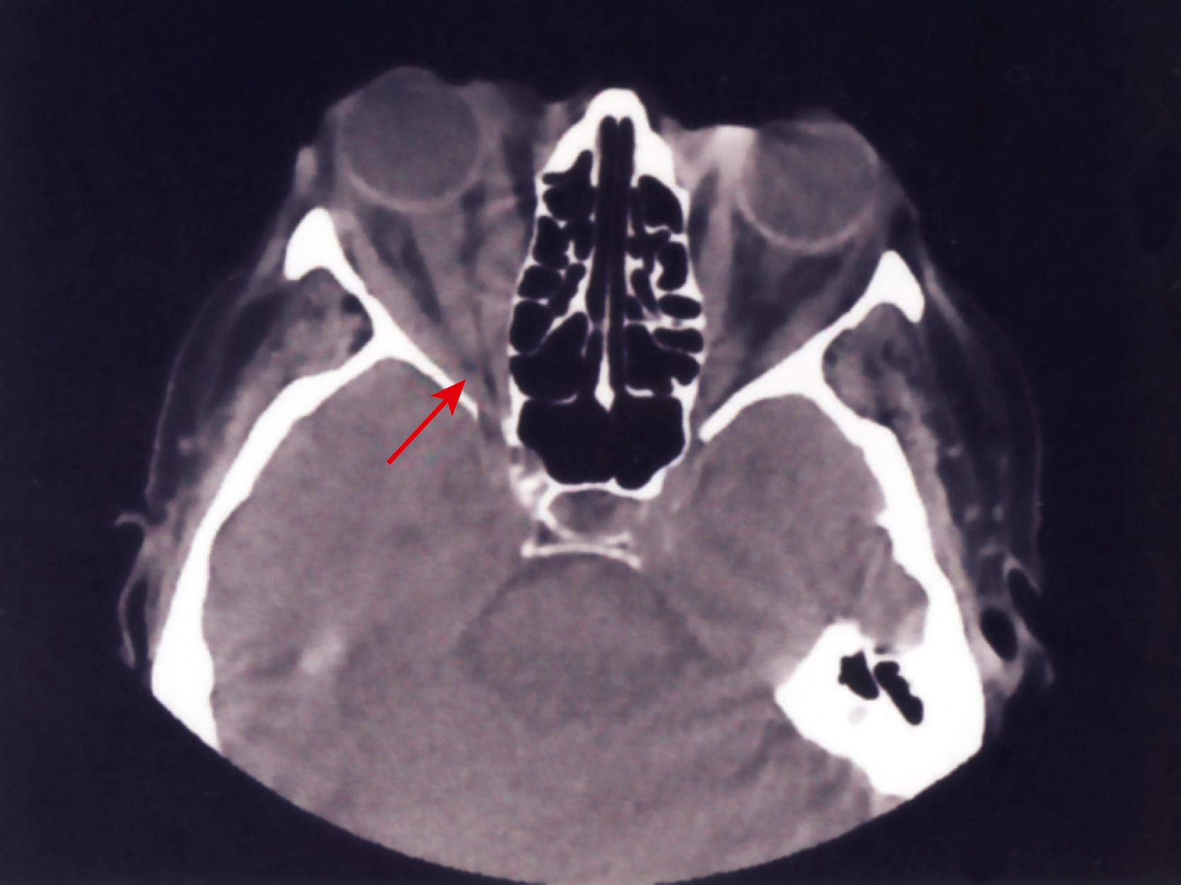 Fig. 151.3, Patient with Graves orbitopathy, optic neuropathy in the right eye, visual acuity of 20/50 in the right eye, and Ishihara color vision of 1.5 of 11 plates. Note the apical crowding (arrow) .