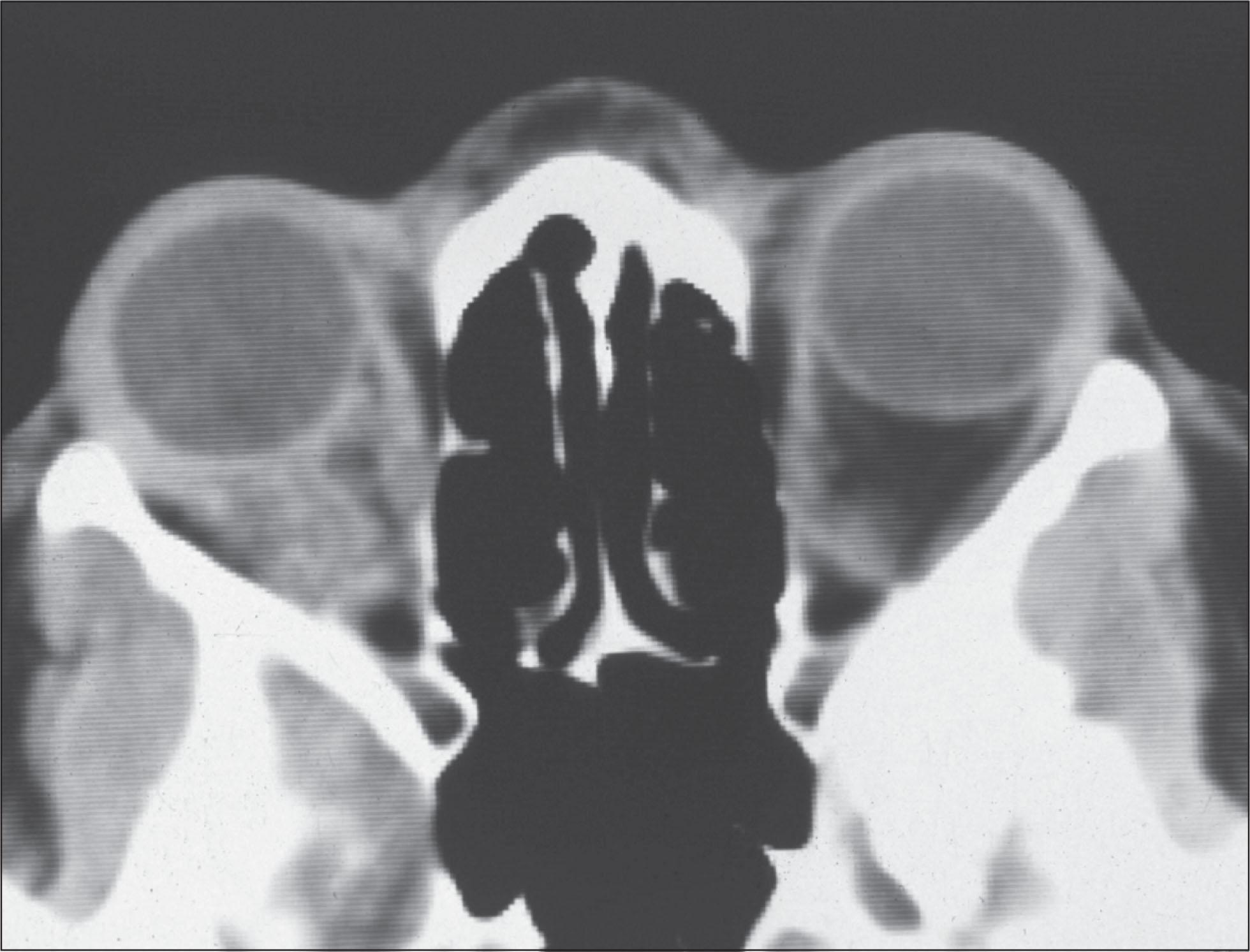 Fig. 12.10.2, Computed Tomography Scan of a Metastatic Breast Carcinoma With an Irregular Mass in the Right Retrobulbar Orbit.