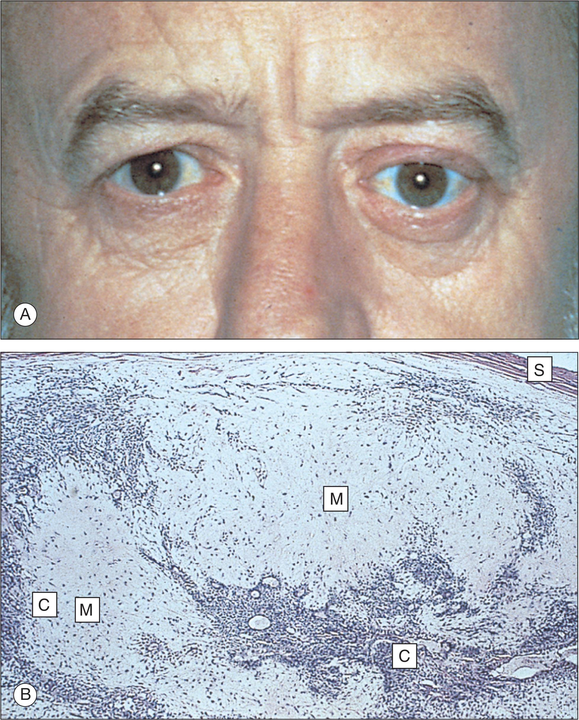 Fig. 12.10.3, Benign Mixed Tumor.