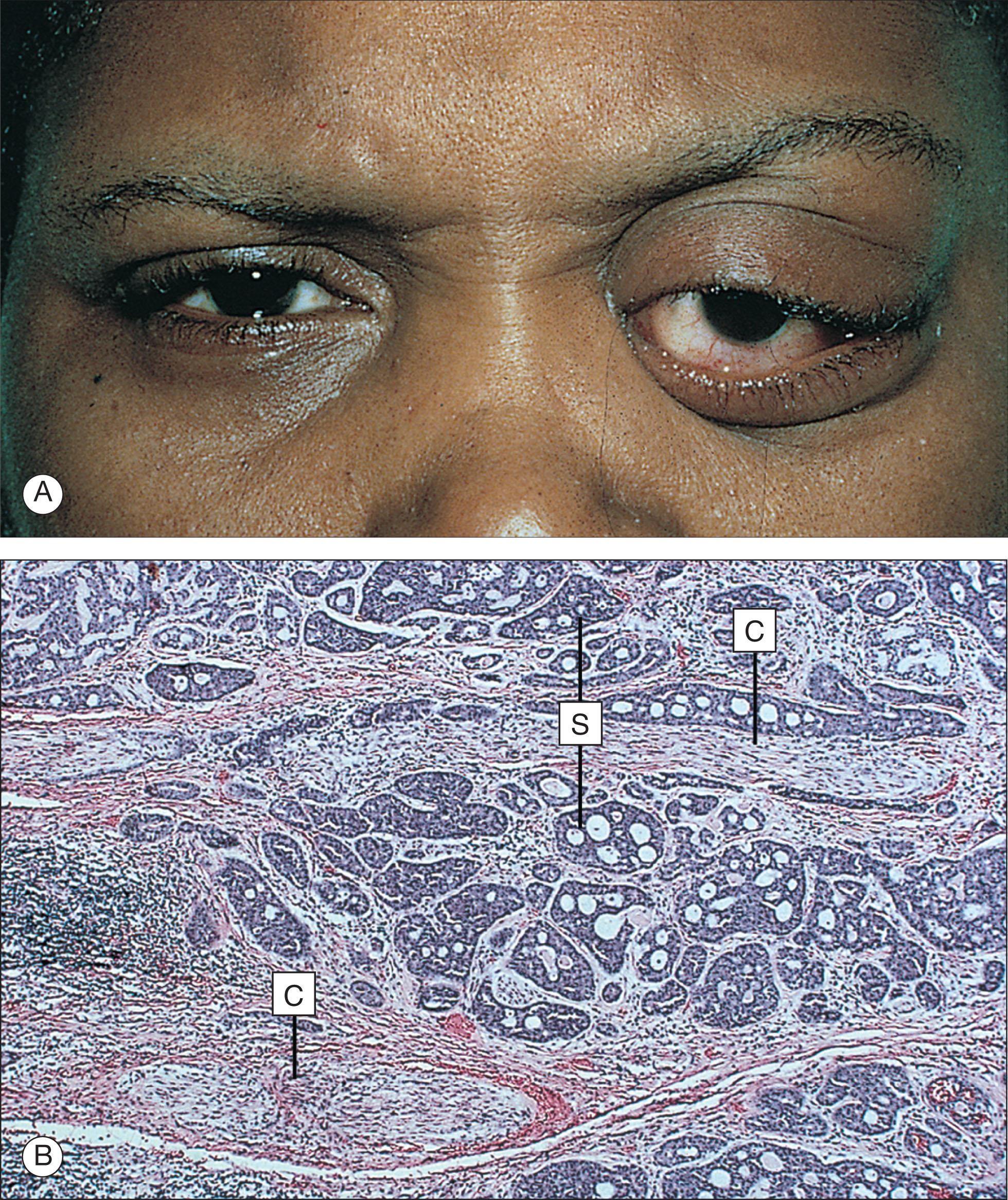 Fig. 12.10.4, Adenoid Cystic Carcinoma.