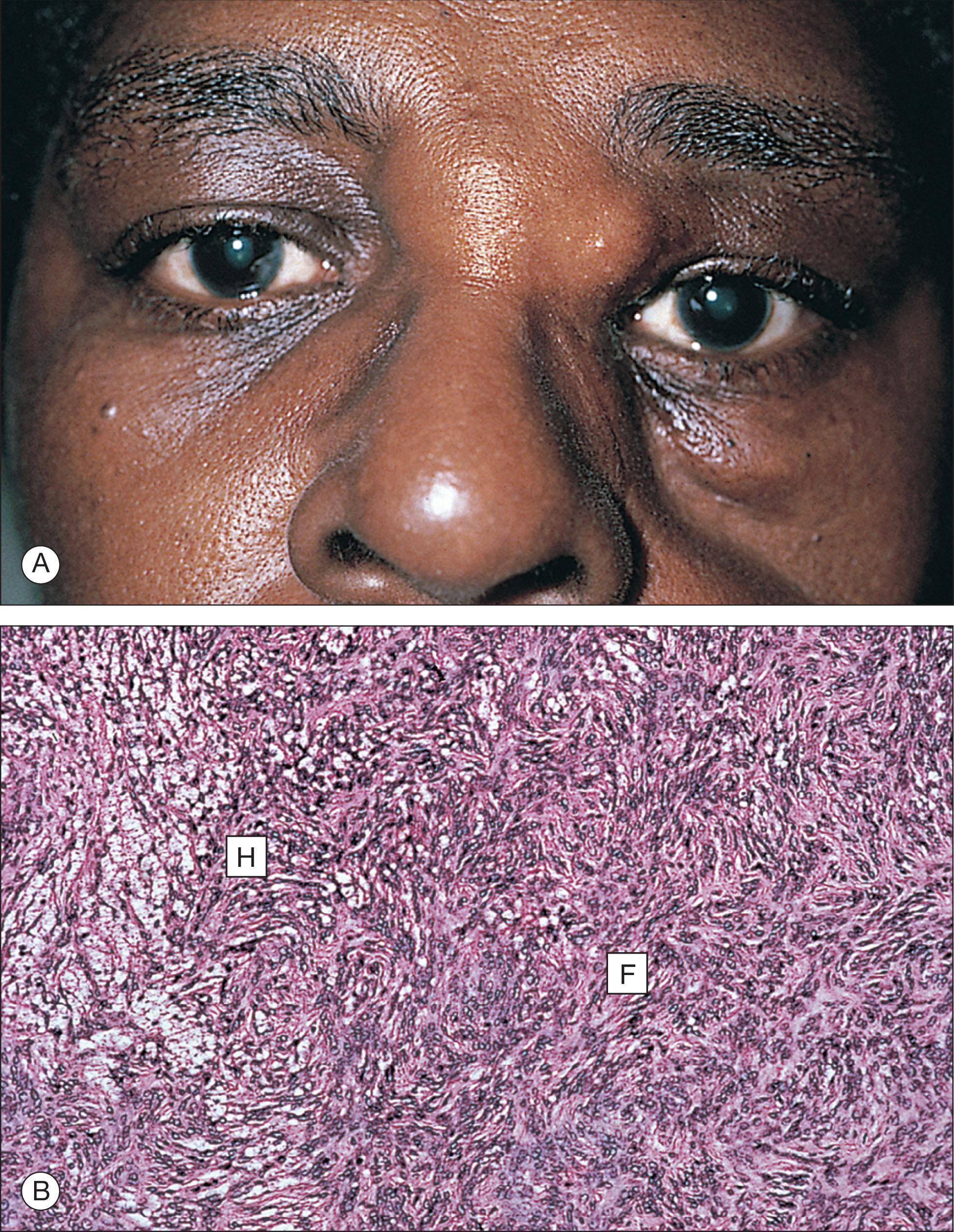 Fig. 12.10.5, Fibrous Histiocytoma.