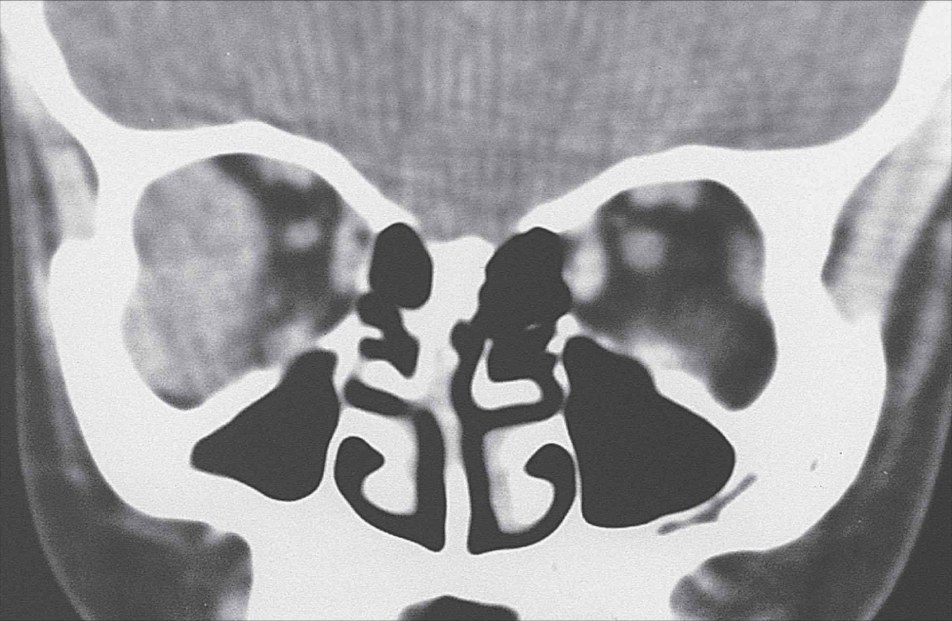 Fig. 12.10.6, Rhabdomyosarcoma of the Lateral Orbital Wall in a 7-Year-Old Girl.