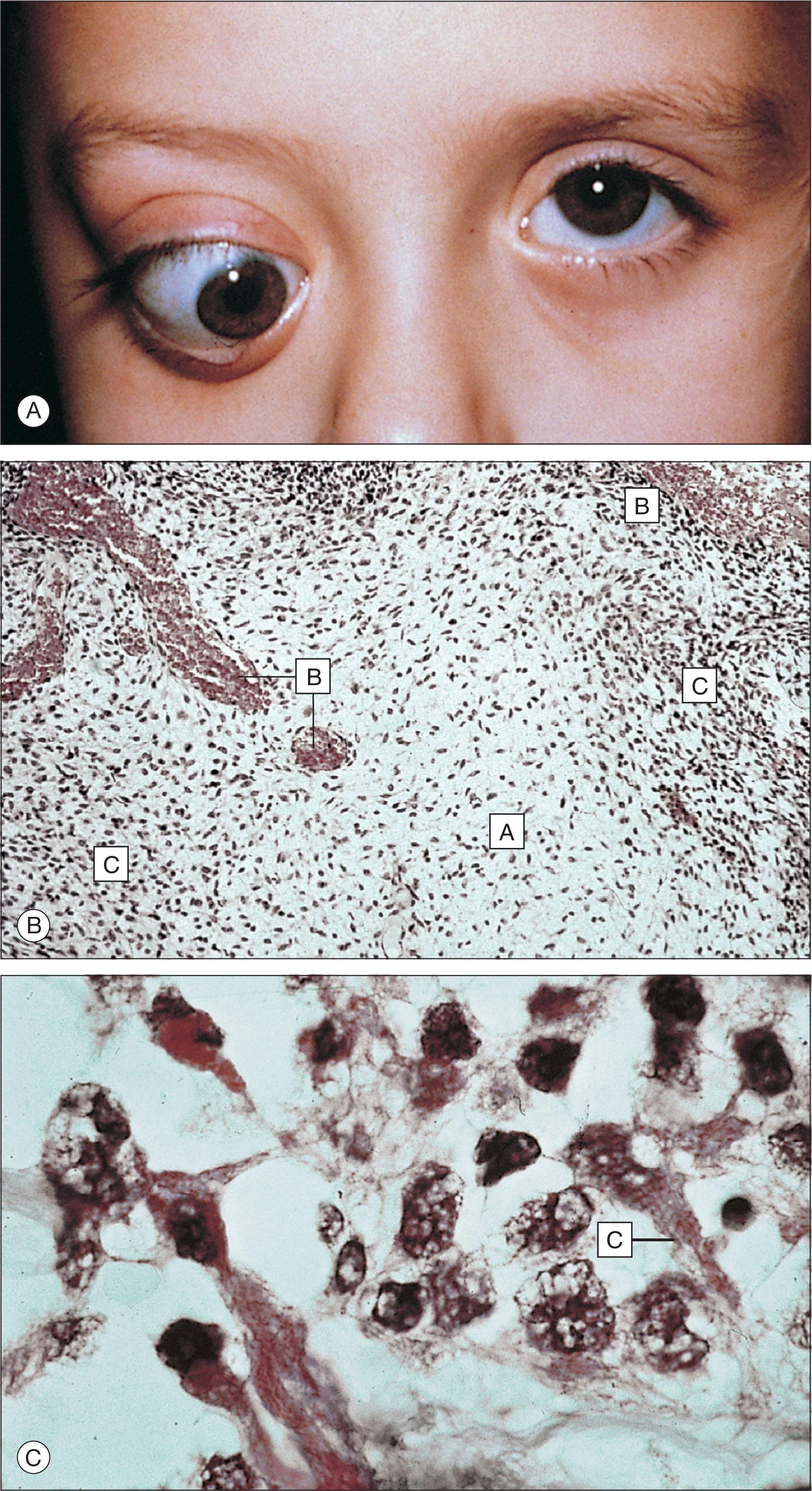 Fig. 12.10.7, Embryonal Rhabdomyosarcoma.