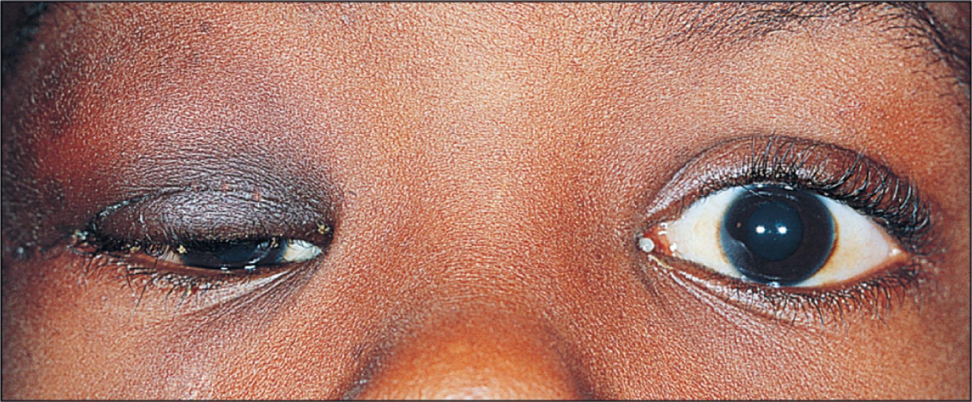 Fig. 12.10.8, Plexiform Neurofibroma of the Right Eyelid in a Child With Neurofibromatosis.