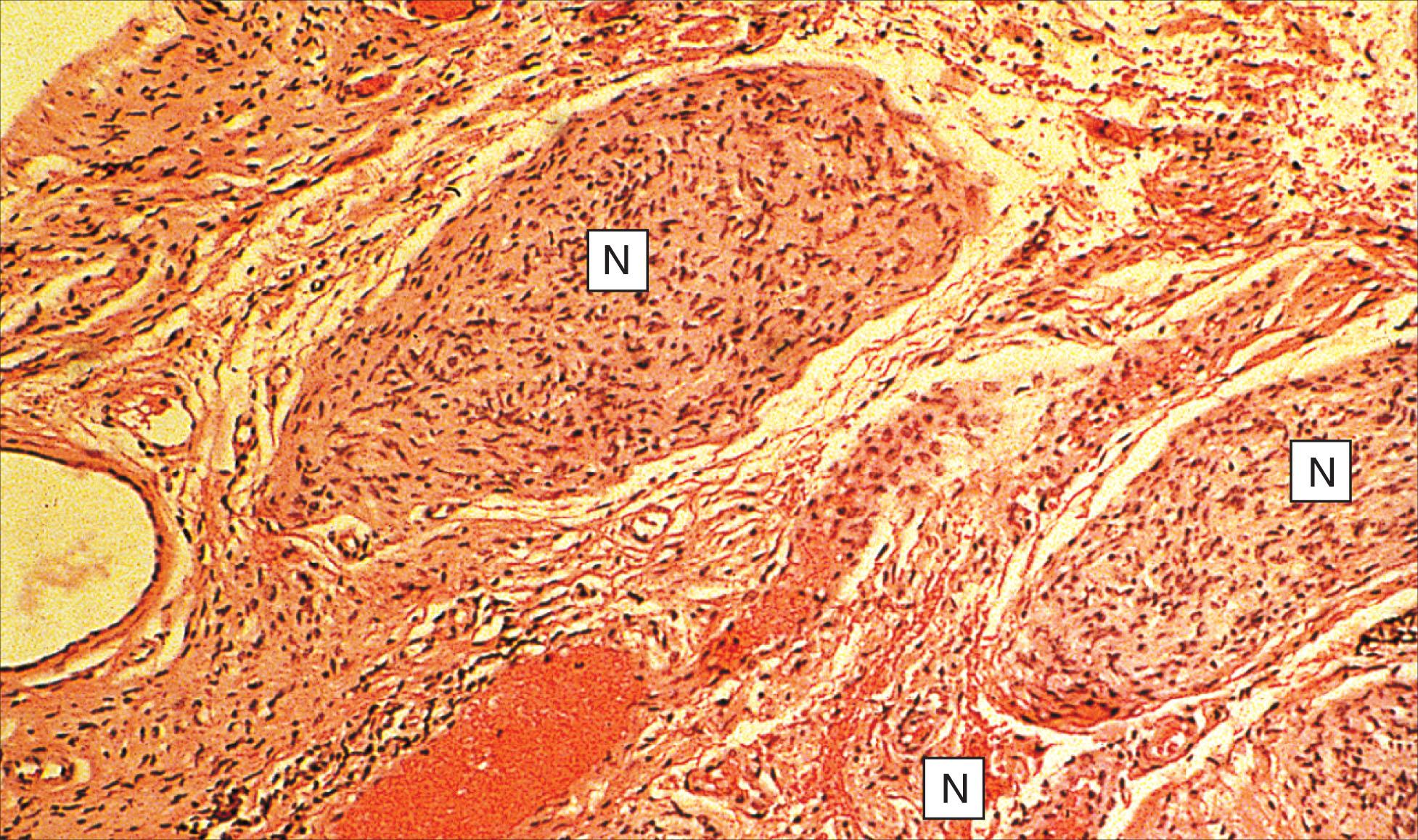 Fig. 12.10.9, Plexiform Neurofibroma.