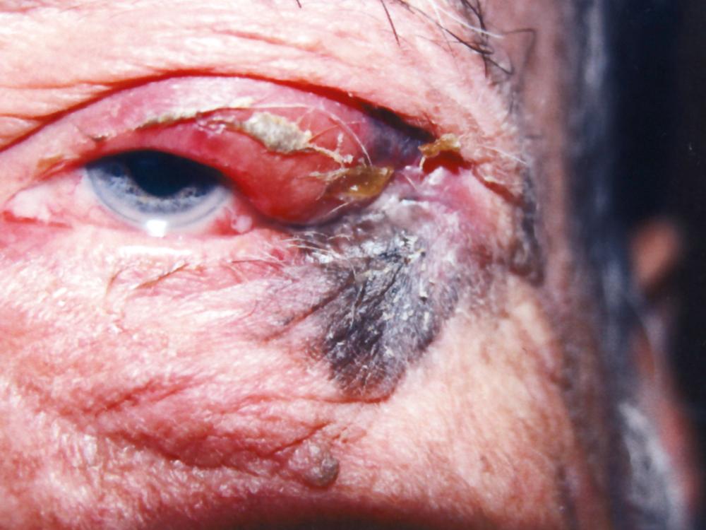 Fig. 154.2, Advanced cutaneous melanoma of the eyelid with orbital extension.