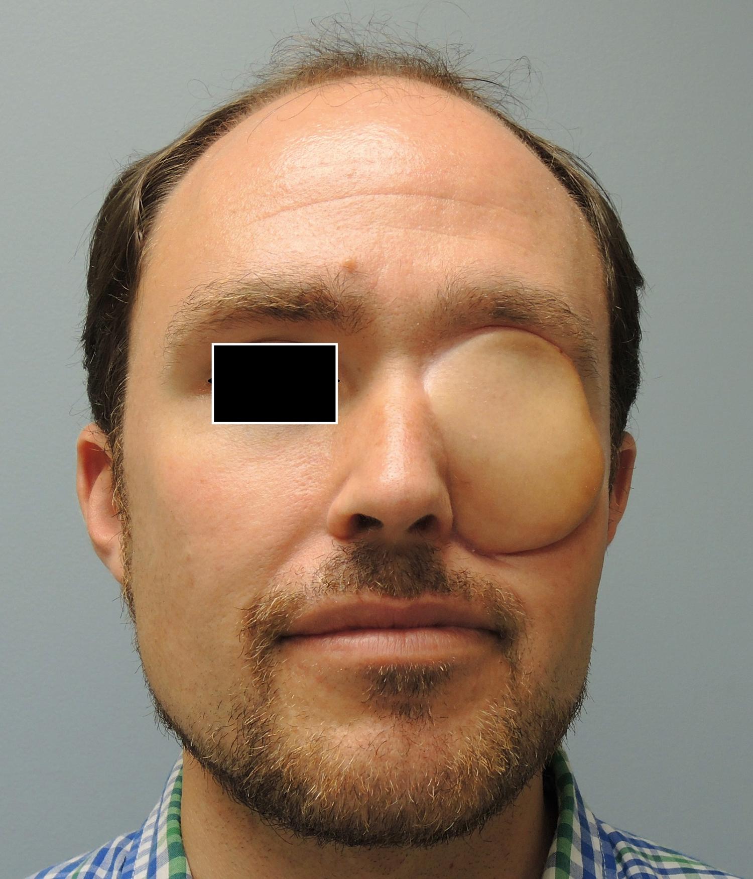 Fig. 154.5, Patient 1 year after left orbital exenteration for adenoid cystic carcinoma arising in left maxilla, reconstructed with an anterolateral thigh free flap.