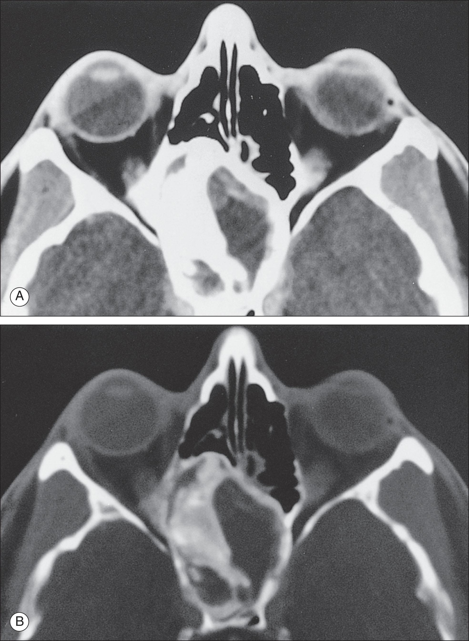 Fig. 12.3.1, Axial Computed Tomography of the Orbits.