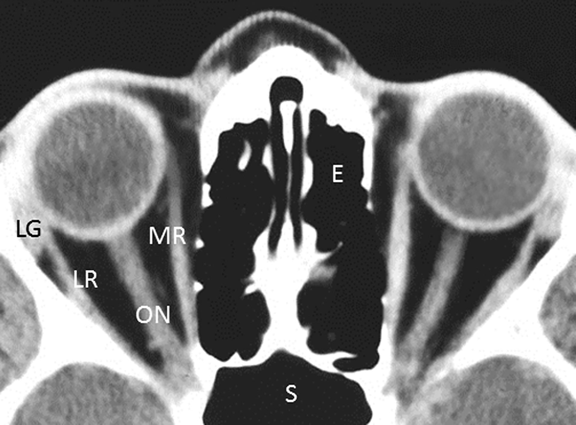 Fig. 12.3.2, Axial Computed Tomography Scan Through the Midorbit.