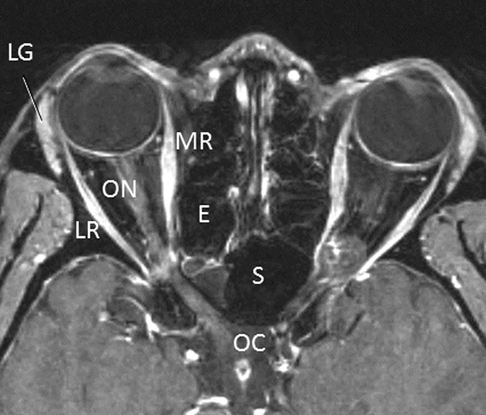 Fig. 12.3.3, Axial Magnetic Resonance Imaging Scan Through the Midorbit.