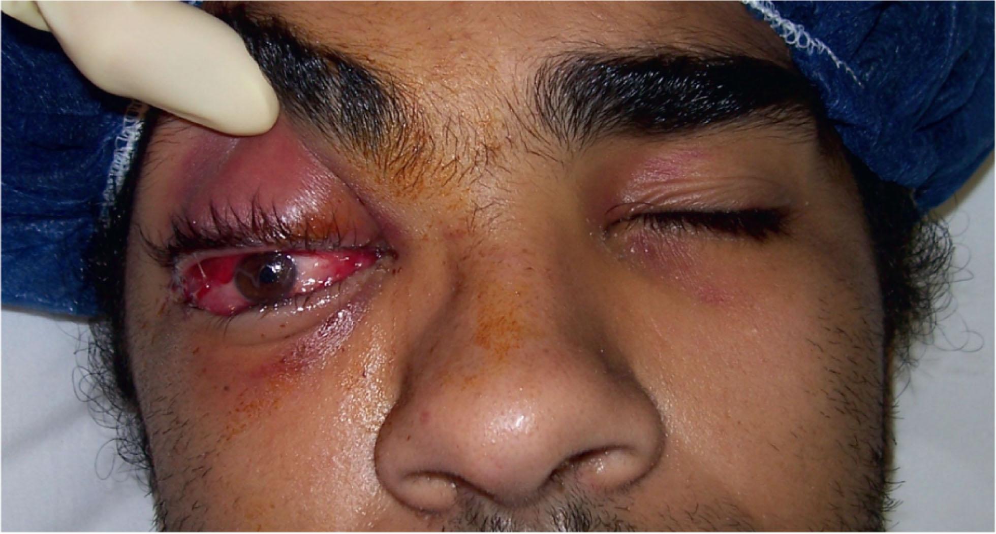 Fig. 12.14.1, A Young Man With Severe Right Orbital Cellulitis.