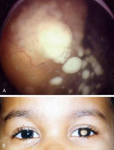 Figure 7.2, Retinoblastoma (RB).