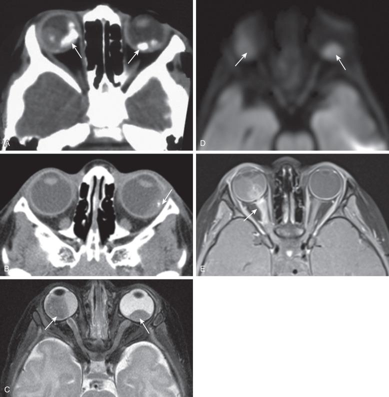 Figure 7.3, Retinoblastoma in four different patients.