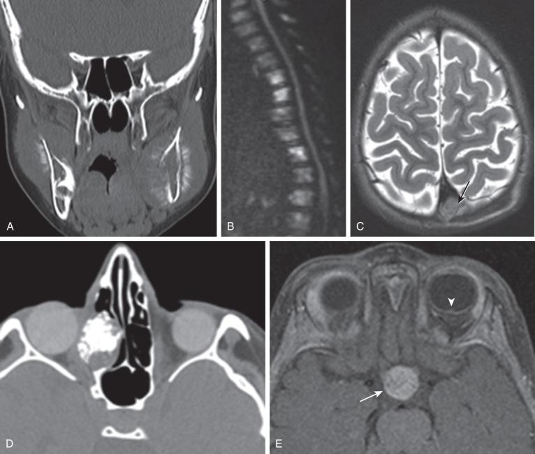 e-Figure 7.4, Metastatic retinoblastoma (RB) in five different patients.