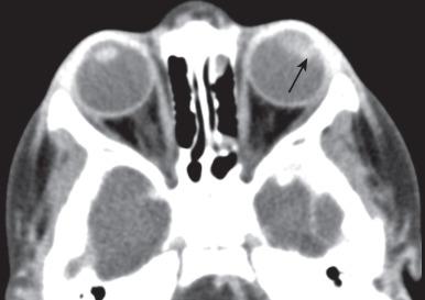 Figure 7.5, Medulloepithelioma .