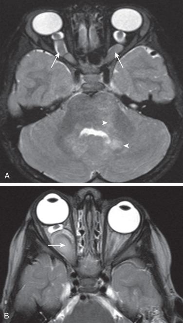 Figure 7.8, Optic nerve glioma (ONG).