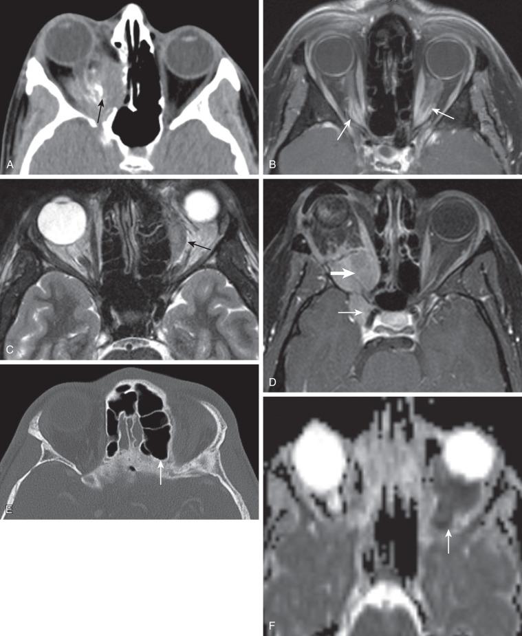 e-Figure 7.9, Orbital meningioma/pediatric primary optic nerve sheath meningioma (PPONSM) in six different patients.