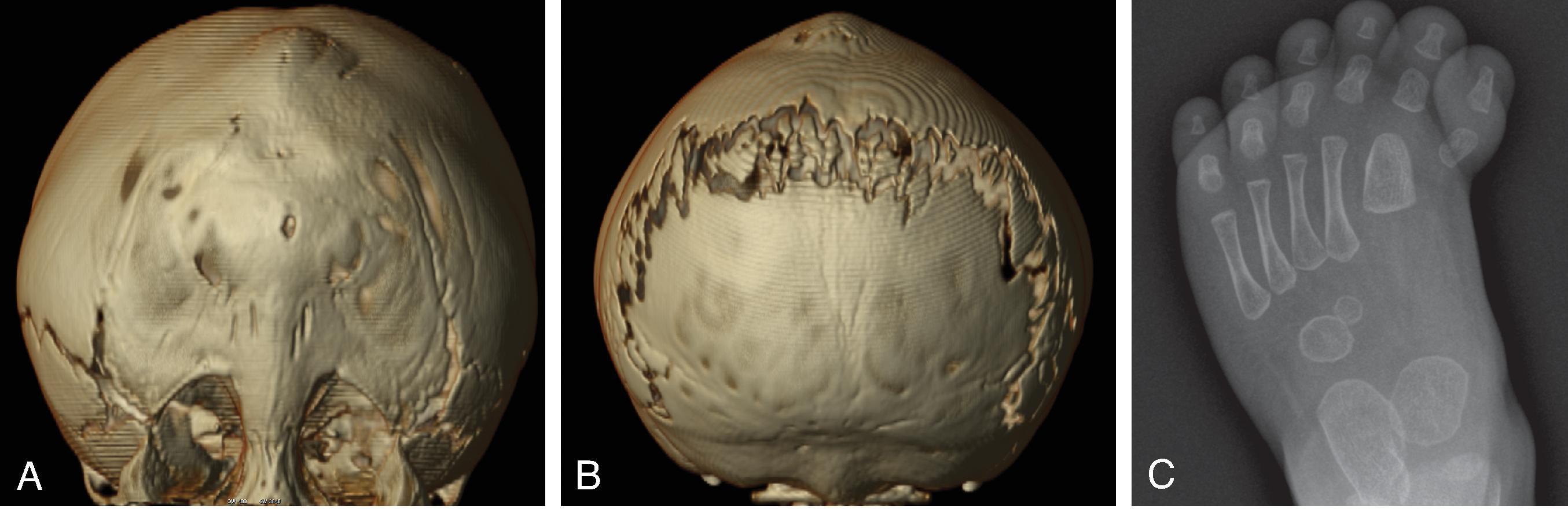 Fig. 12.11, Saethre Chotzen Syndrome . (A and B) 3D volumetric CT images demonstrate wide metopic suture, wide gap between the parietal bones, and bicoronal craniosynostosis. (C) Foot radiograph demonstrating cutaneous syndactyly between the second and third toes.