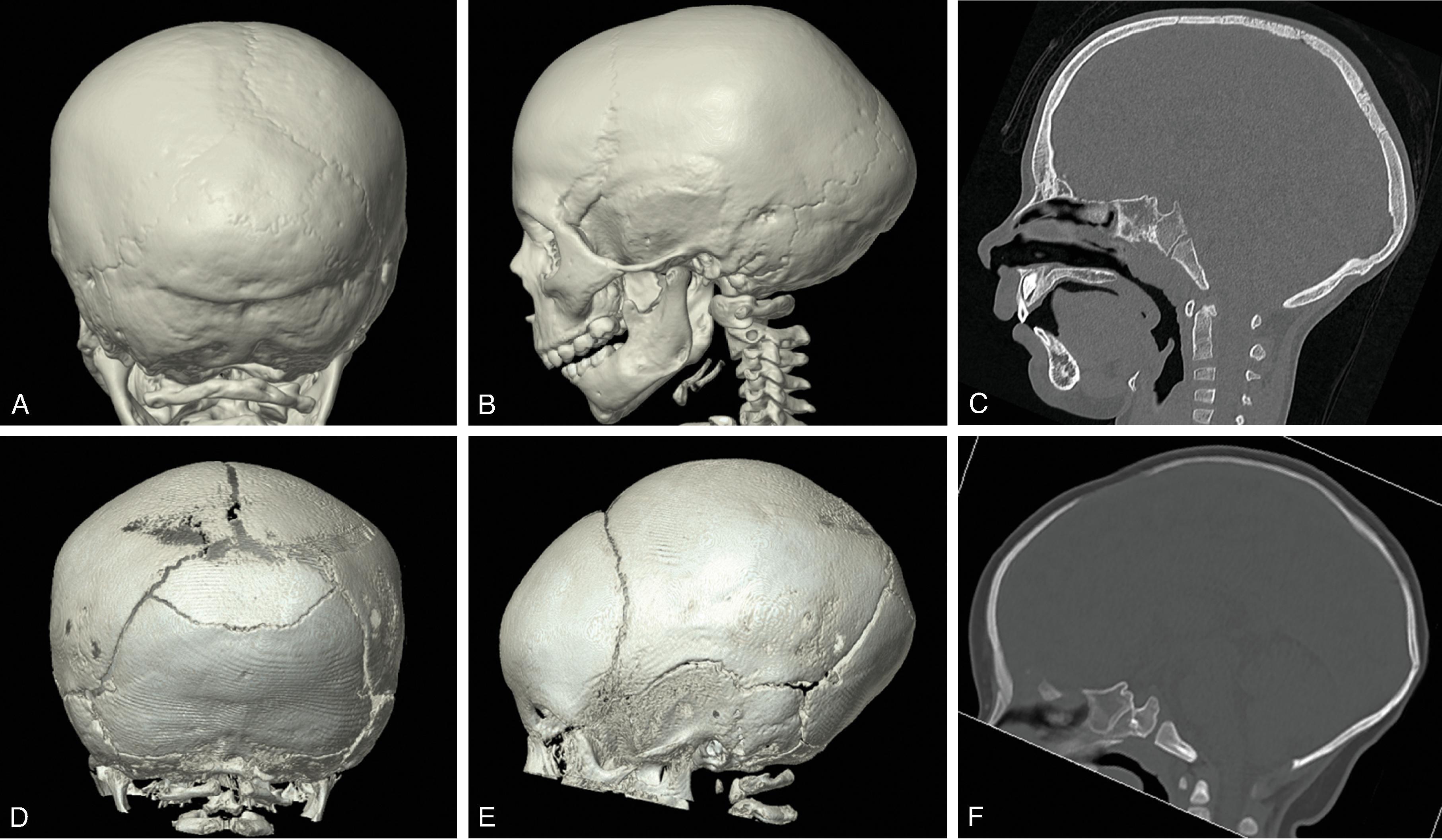 Fig. 12.12, Carpenter Syndrome . (A and B) 3D volumetric CT images demonstrate metopic, sagittal, and bicoronal craniosynostosis, ridging along the midline of the skull, downsloping orbits, and multiple intrasutural ossification centers in the arc-like lambdoid suture. (C) Foot radiograph demonstrating polydactyly.