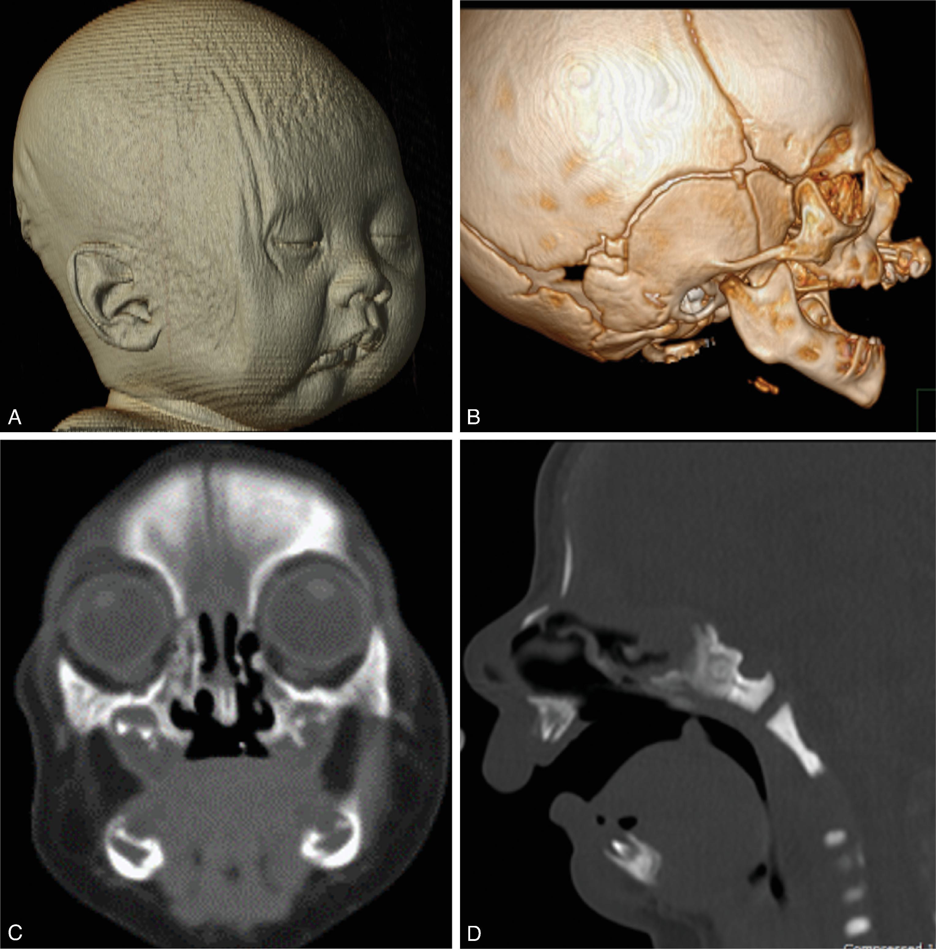 Fig. 12.13, Bathrocephaly . (A to B, D to E) 3D volumetric CT images and (C, F) sagittal reformat CT in two separate patients demonstrating dorsal symmetric midline protuberance of the occipital calvarium with a persistent mendosal suture.